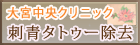 入れ墨除去 タトゥー除去 刺青除去