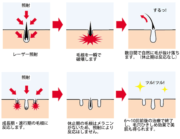 メンズ脱毛の大宮中央クリニック　脱毛の仕組み